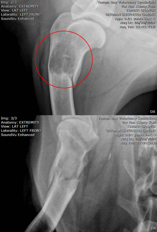 osteosarcoma xray osteosarcoma xray